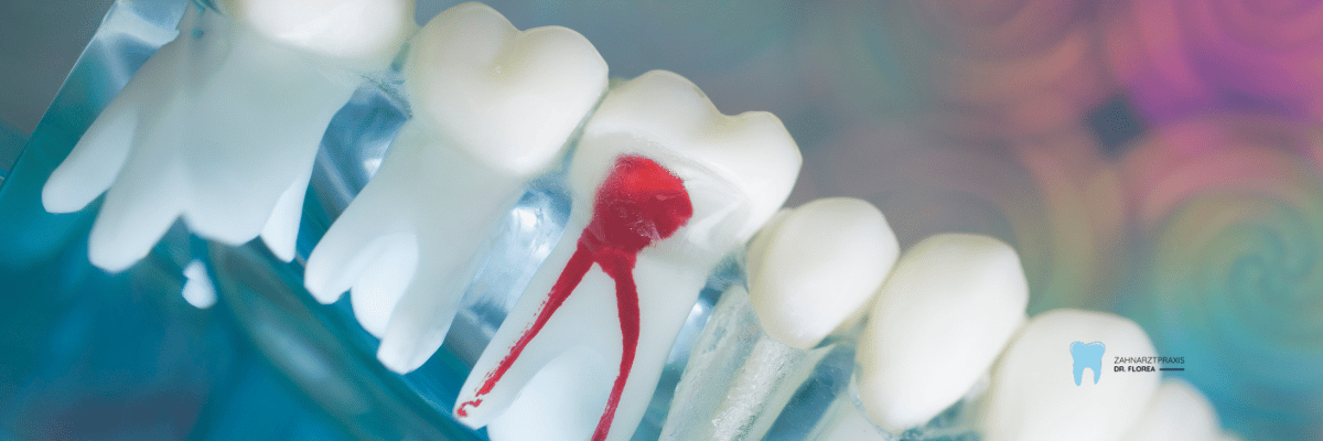 Wurzelbehandlung Zahnmodell Molar