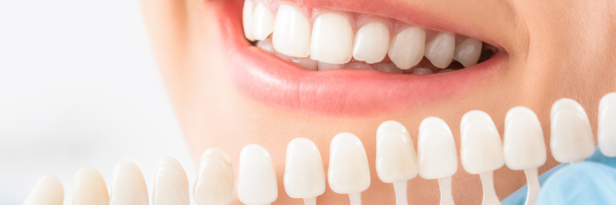 Bleaching zahnarzt Frankfurt